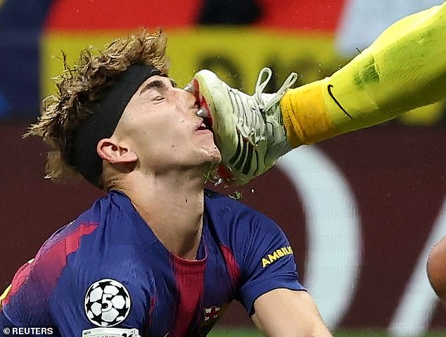 Cầu thủ Barcelona đổ m&aacute;u v&igrave; bị đối thủ đạp gi&agrave;y v&agrave;o mặt - Ảnh 1
