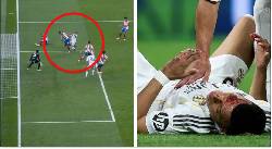 Mbappe đổ máu, Real Madrid bức xúc vì mất phạt đền